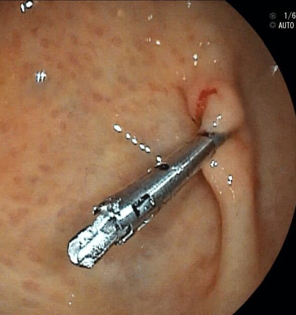 Clip Hemostático